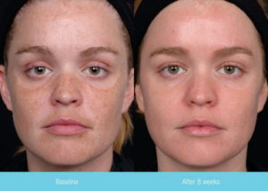 obagi melasma