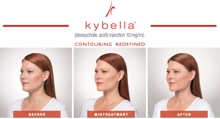 Draw A Different Line With Kybella