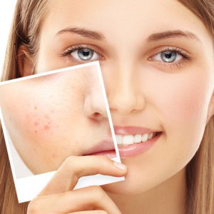 Myths About Acne