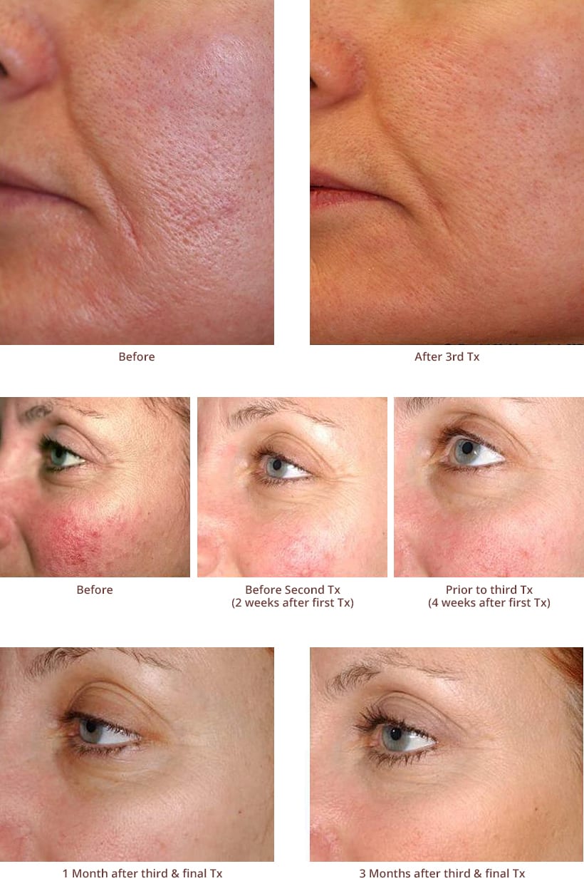 Laser Genesis Before And After Photos
