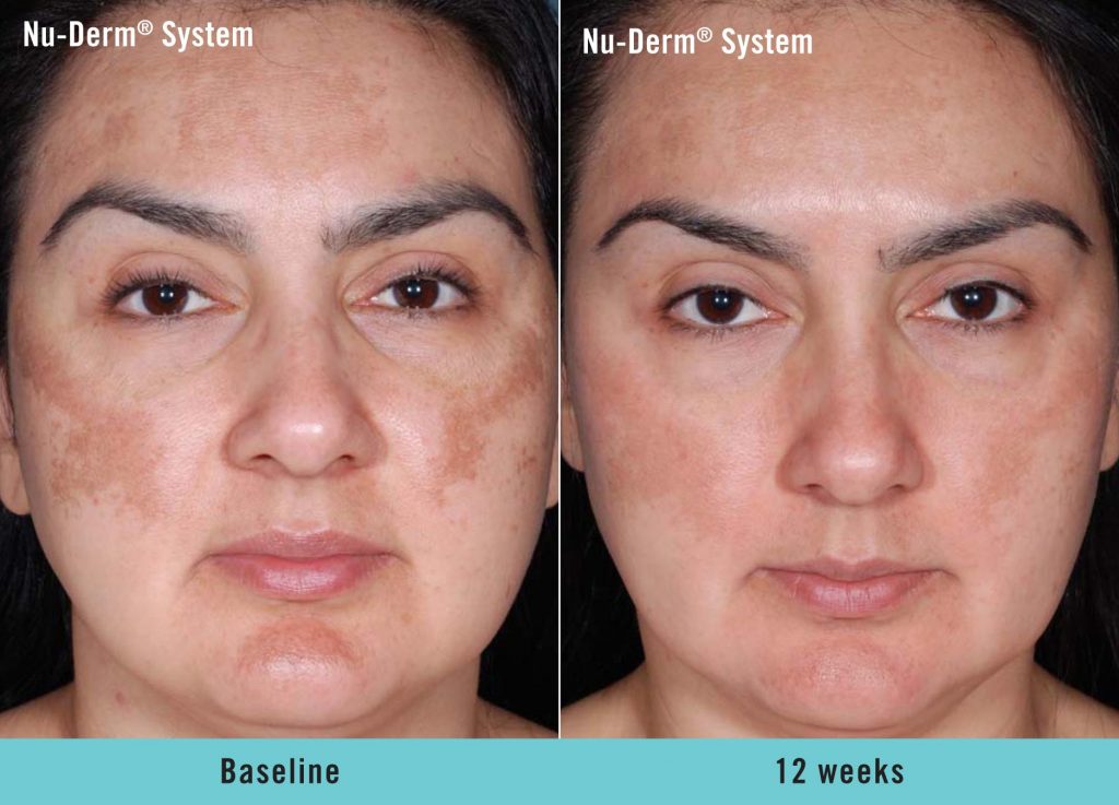 5 Phases Of Obagi Nu Derm Transformation